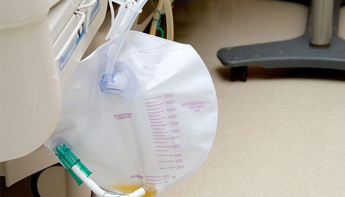 Urinary Catheter, a Foley Bag